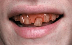 Rotten Goblin SFX Veneer Zähne